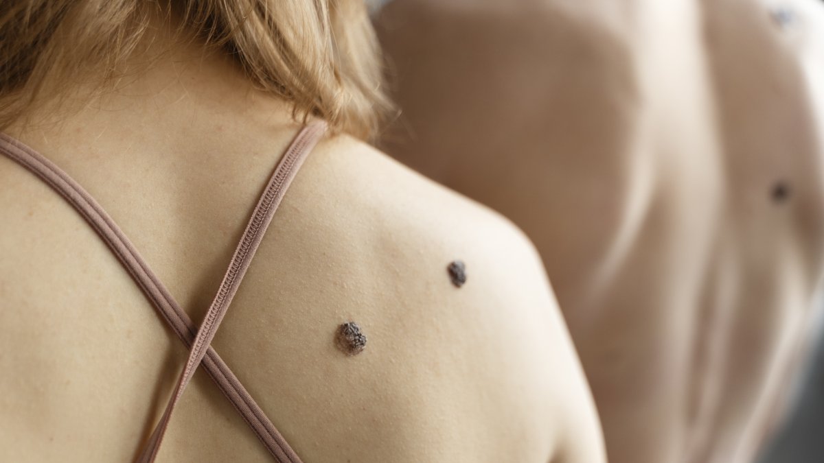 Todo lunar debería ser valorado por un especialista.