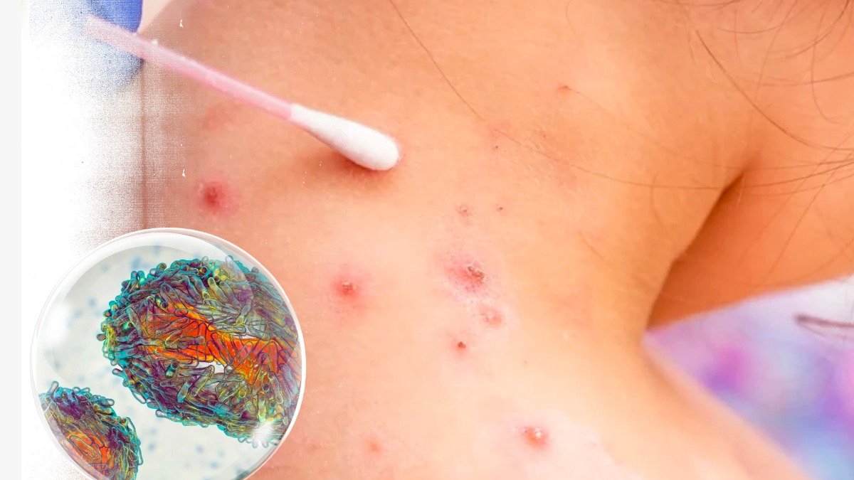 Los casos registrados en 2024 han sido cinco y los síntomas fueron leves, asegura el MSP.