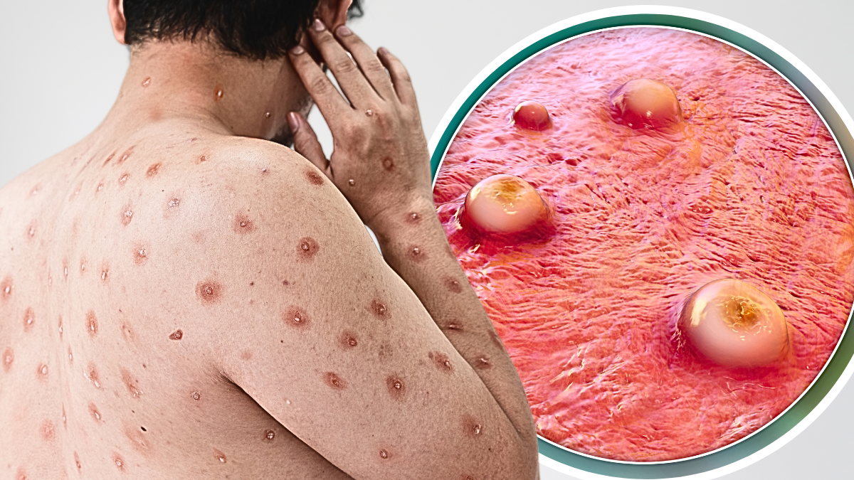 Hay cinco casos de viruela del mono en Ecuador, pero no de la nueva variante.