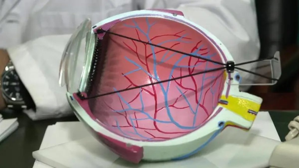 El síndrome de ojo seco puede causar lesiones en la superficie ocular que podrían dañar la córnea.