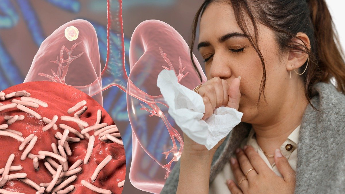 Grafico referente a tuberculosis