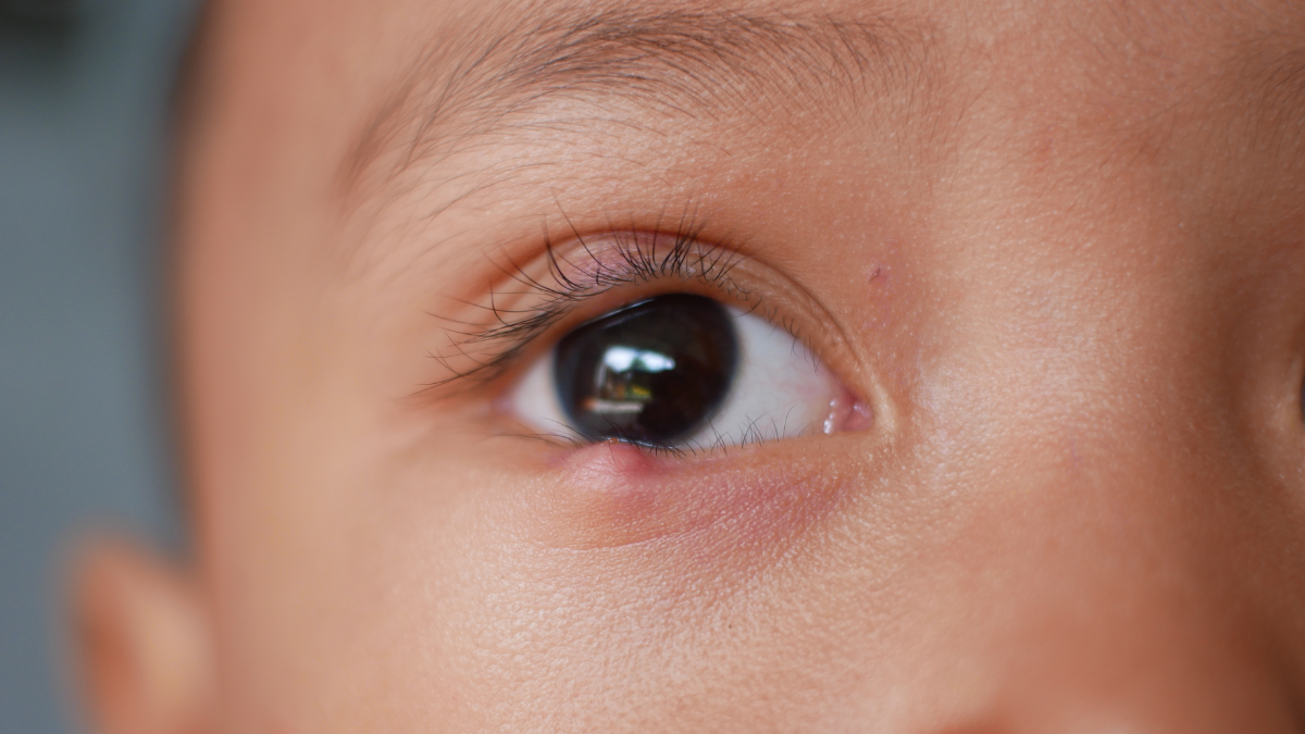 El herpes labial en niños puede causar daños oculares graves si no se trata a tiempo.