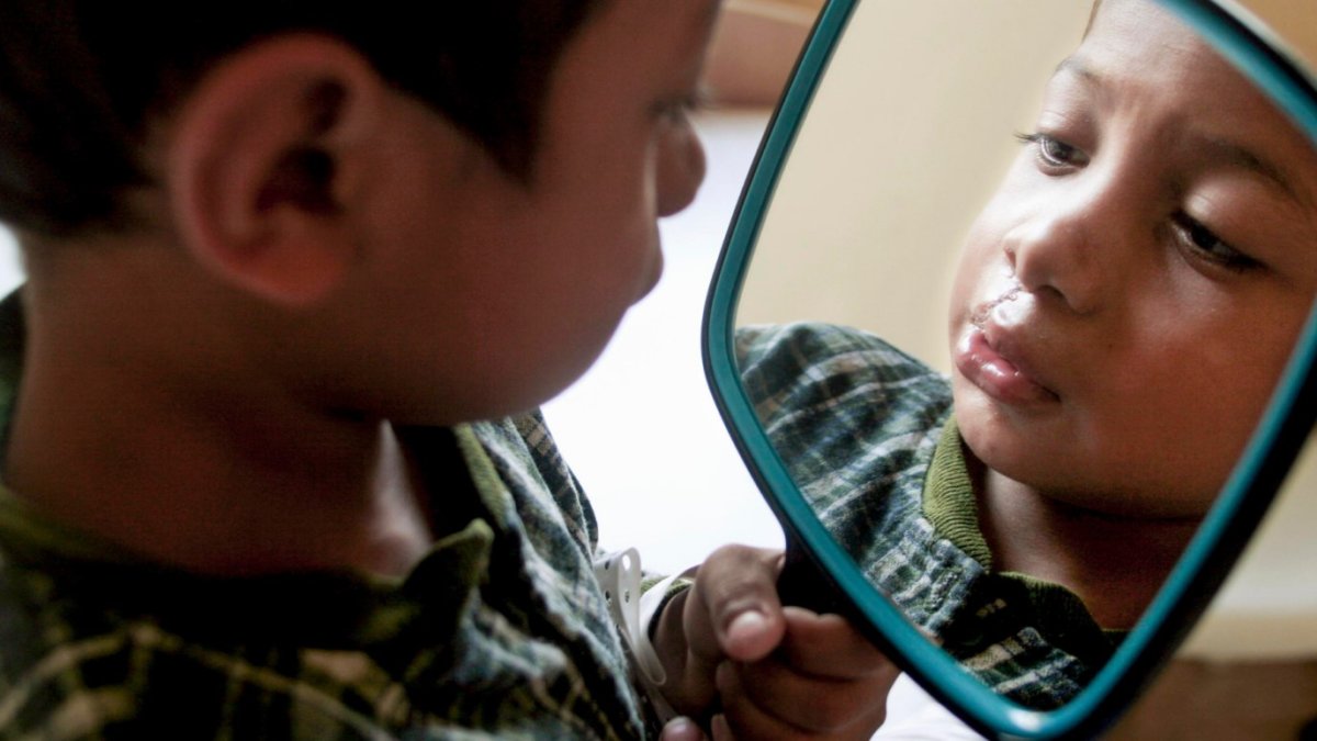 La Fundación Operación Sonrisa trabaja para mejorar la calidad de vida de niños, jóvenes y adultos con fisura labiopalatina