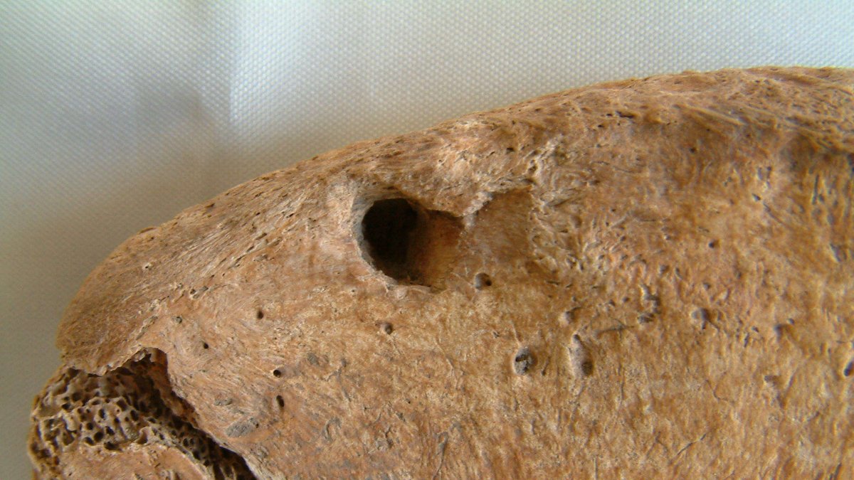 Marca de diente de león en el hueso de la cadera. 