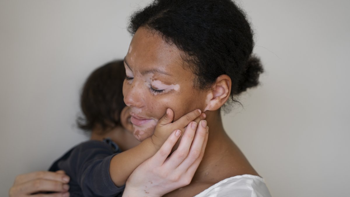 El vitiligo afecta entre el 0,5 % y el 2 % de la población mundial