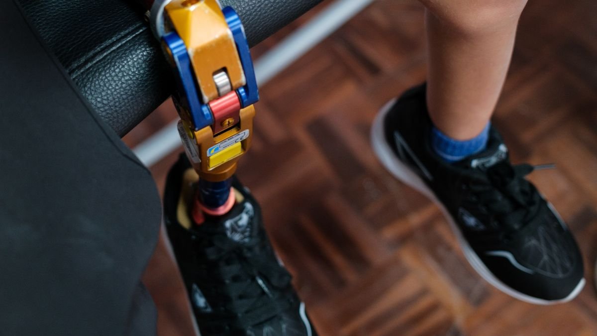 En Ecuador, miles aún esperan una prótesis, ROMP trabaja para que no sea un privilegio.