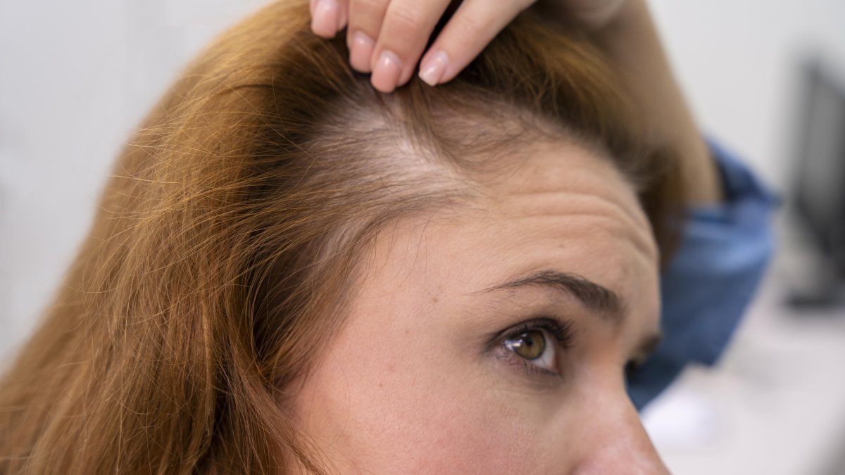 Es posible que el fin de la alopecia esté cerca