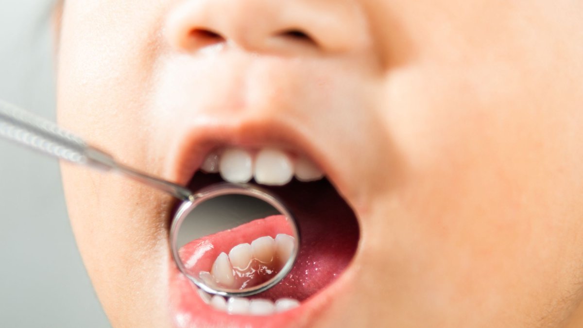 La caries dental continúa siendo una de las enfermedades más frecuentes en Ecuador, afectando especialmente a niños y escolares.