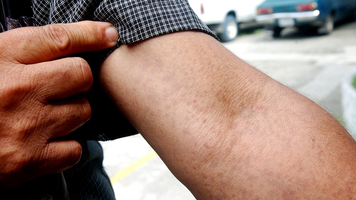 Casos de enfermedades en la piel suben 27,9% en Guayaquil en 2026.