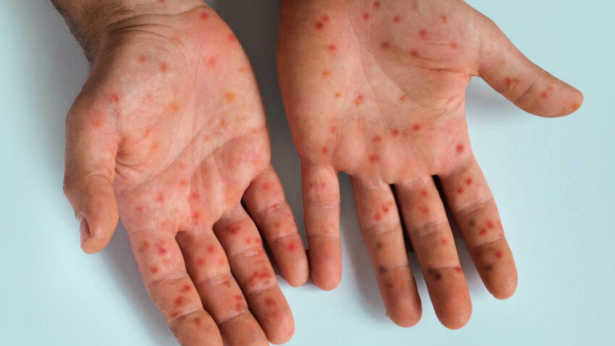 Erupciones o lesiones cutáneas aparecen en la cara, las palmas de las manos y las plantas de los pies en casos de viruela símica o mpox.