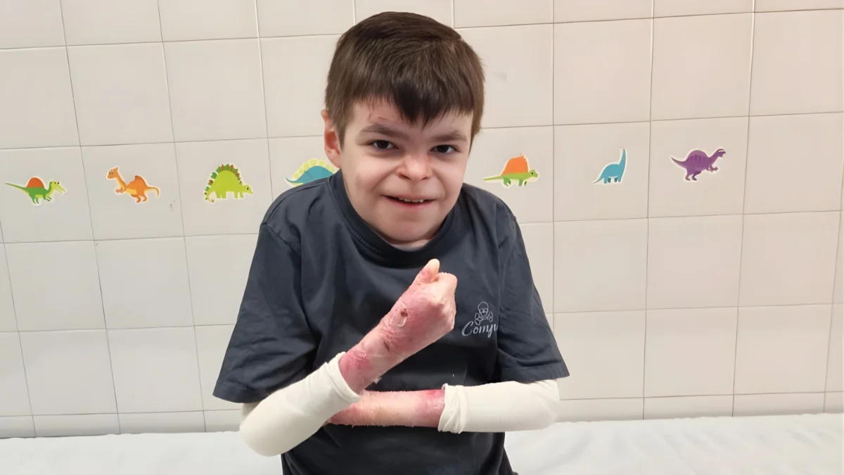 Leo, de 12 años, inicia en Sevilla la terapia génica Vyjuvek para tratar la Piel de Mariposa.