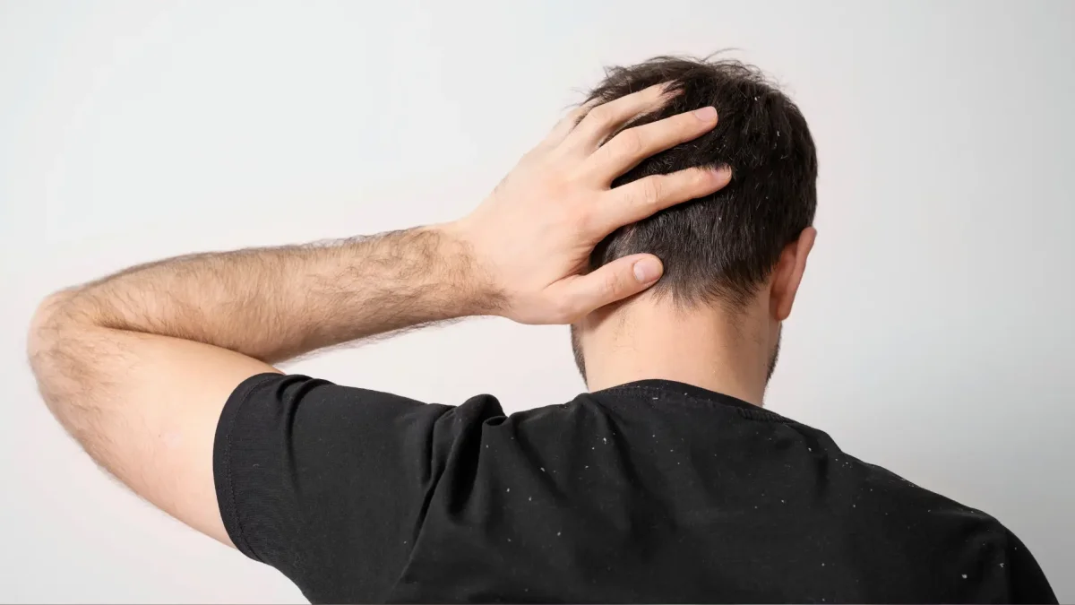 La psoriasis en el cuero cabelludo puede ser una señal de artritis psoriásica, por lo que es importante consultar con un médico sobre su aparición.