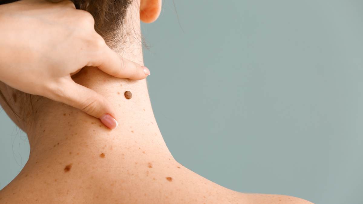 Moderna y Merck anunciaron resultados positivos de una terapia personalizada de ARNm contra el melanoma.
