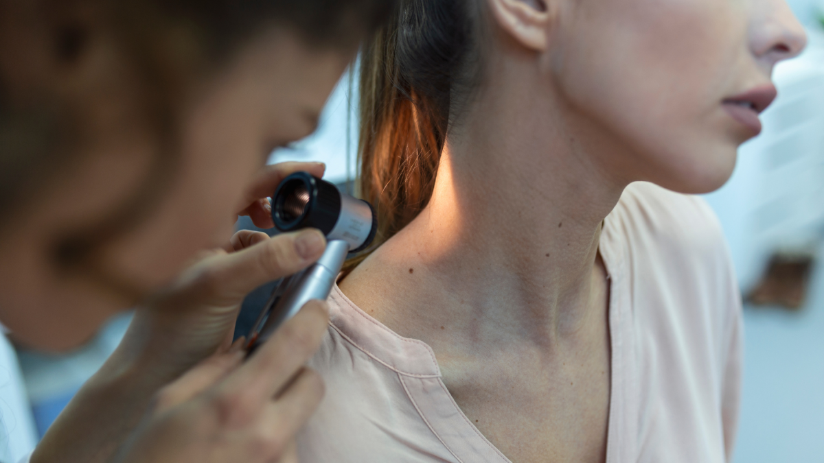Tener más de 50 lunares en el cuerpo sería una señal de un mayor riesgo de desarrollar cáncer.