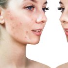 Antes y después de rostro con secuelas de acné.