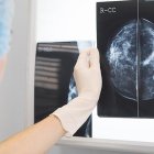 El IA de Google ha demostrado ser tan eficaz como los radiólogos más expertos a la hora de detectar qué mujeres tenían cáncer de mama durante el estudio.