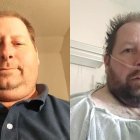 Brian Hitchens, antes y después de la infección.