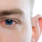 Identifican la conjuntivitis como síntoma principal de la Covid-19.