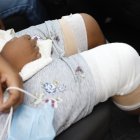 Los médicos suturaron las heridas provocadas por las mordeduras de la mascota.