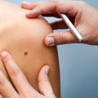 El sistema que analiza las fotografías puede clasificar y distinguir lesiones cutáneas sospechosas, potencialmente pre-cancerosas.