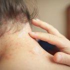 El enrojecimiento en la piel puede causar dolor y picor