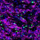 Un corte transversal de tejido tumoral pancreático de ratón