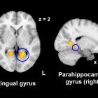 La activación cerebral en el giro lingual y en el giro parahipocampal, áreas involucradas en la percepción del dolor, disminuyó significativamente después de ver imágenes nostálgicas en comparación con las imágenes de control.
