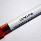 Referencial hepatitis.