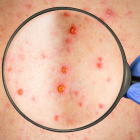 Referencial de la viruela del mono manifiesta en la piel.