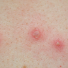 Viruela, referencial.