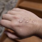 Erupción viruela del mono