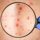 Las erupciones en la piel es uno de los síntomas de la viruela del mono.