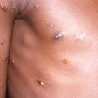 La viruela del mono produce lesiones cutáneas, fiebre y dolor corporal en las personas afectadas por el virus.