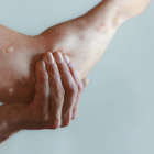 Referencial de viruela del mono.