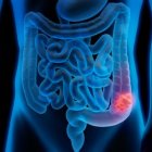 Imagen archivo cáncer de colon