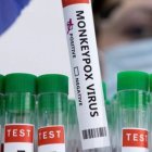 Foto archivo viruela del mono