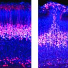 Neuronas piramidales de la capa cinco del córtex en ratones normales (izquierda) comparados con ratones con el gen del autismo eliminado (derecha), mostrando un parche de corteza desorganizada.