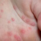 Imagen facilitada por la Asociación Española de Pediatría de un paciente afectado por  el síndrome de manos, pies y boca.