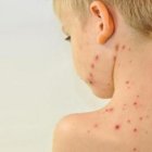 Imagen referencial de niño con sarampión.