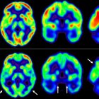 Las imágenes representan la captación de glucosa en el cerebro en individuos de mediana edad con bajo (arriba) o alto (abajo) riesgo cardiovascular sostenido 5 años.