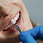 Conoce más sobre las ventajas y desventajas de las carillas dentales o veeners