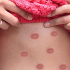 Viruela del mono es declarada emergencia de salud pública global.