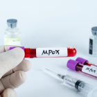 La mejor forma de detectar la presencia de la viruela del mono es a través de pruebas de laboratorio