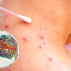 Los casos registrados en 2024 han sido cinco y los síntomas fueron leves, asegura el MSP.