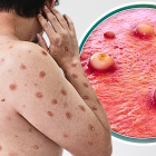 Hay cinco casos de viruela del mono en Ecuador, pero no de la nueva variante.