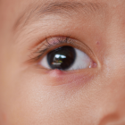 El herpes labial en niños puede causar daños oculares graves si no se trata a tiempo.