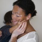 El vitiligo afecta entre el 0,5 % y el 2 % de la población mundial