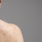 Confundir hidradenitis supurativa con acné puede empeorar tu condición. Aprende a identificar las señales distintivas