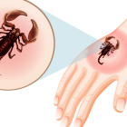 Imagen simbólica de picadura de alacrán.