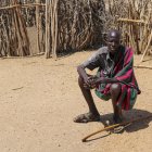Ekai Akumal Losike, padece de micetoma en una aldea situada alrededor de una hora y media de Todwar, capital del condado keniano de Turkana.